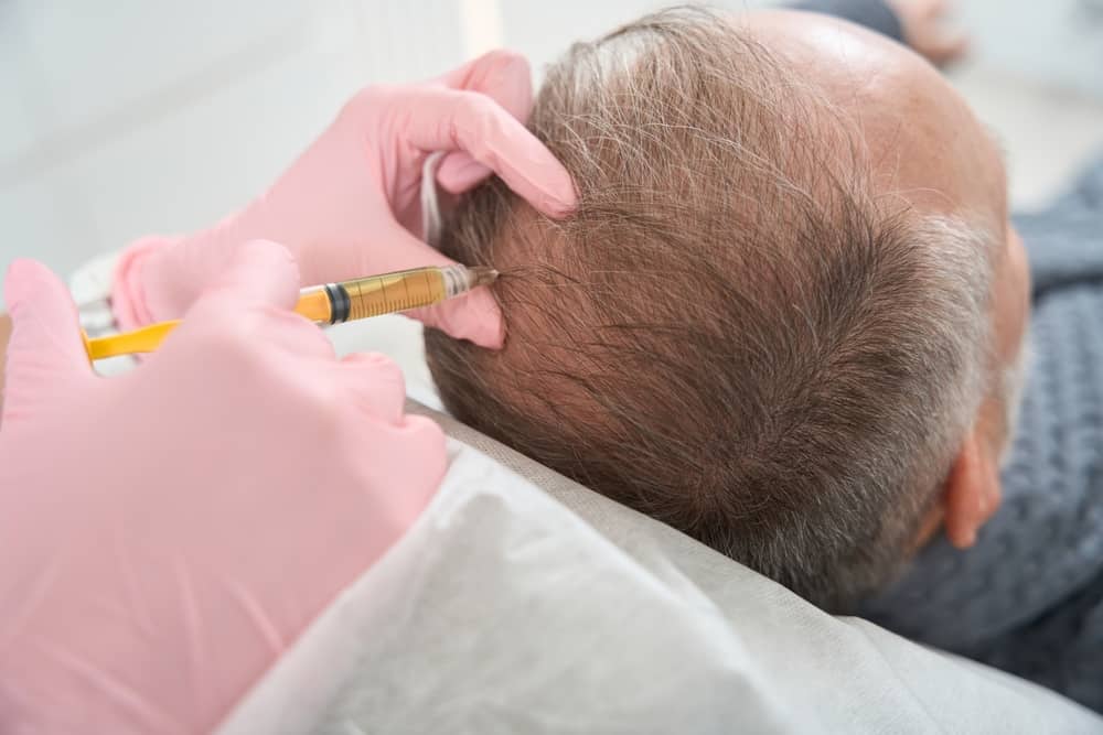 PRP hair loss treatment injection being administered to male patient's scalp by medical professional wearing gloves