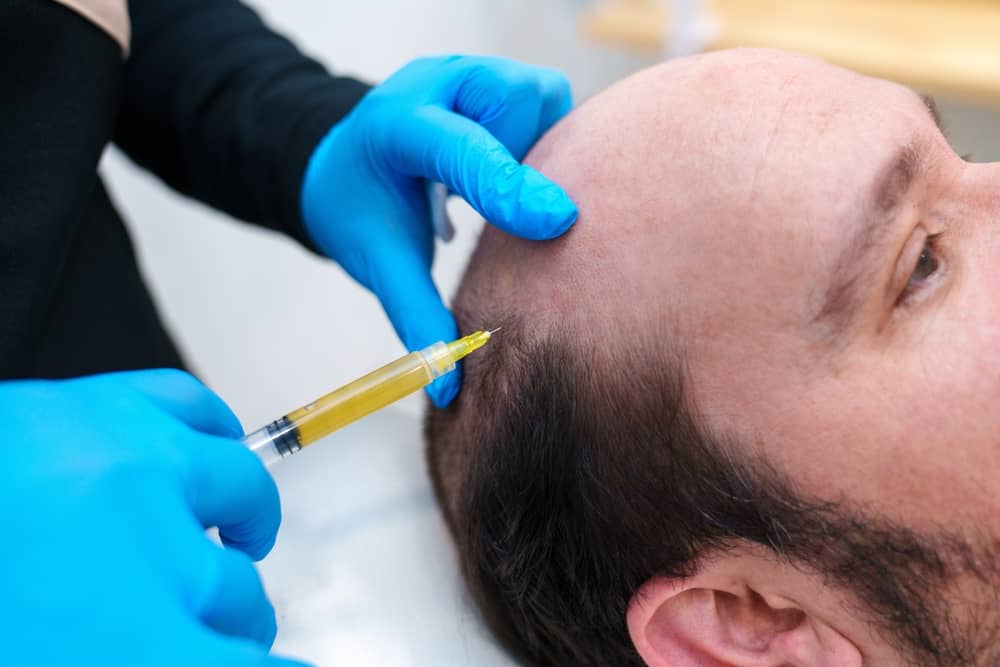 Medical professional injecting PRP platelet rich plasma into male patient's scalp for hair loss treatment at hairline