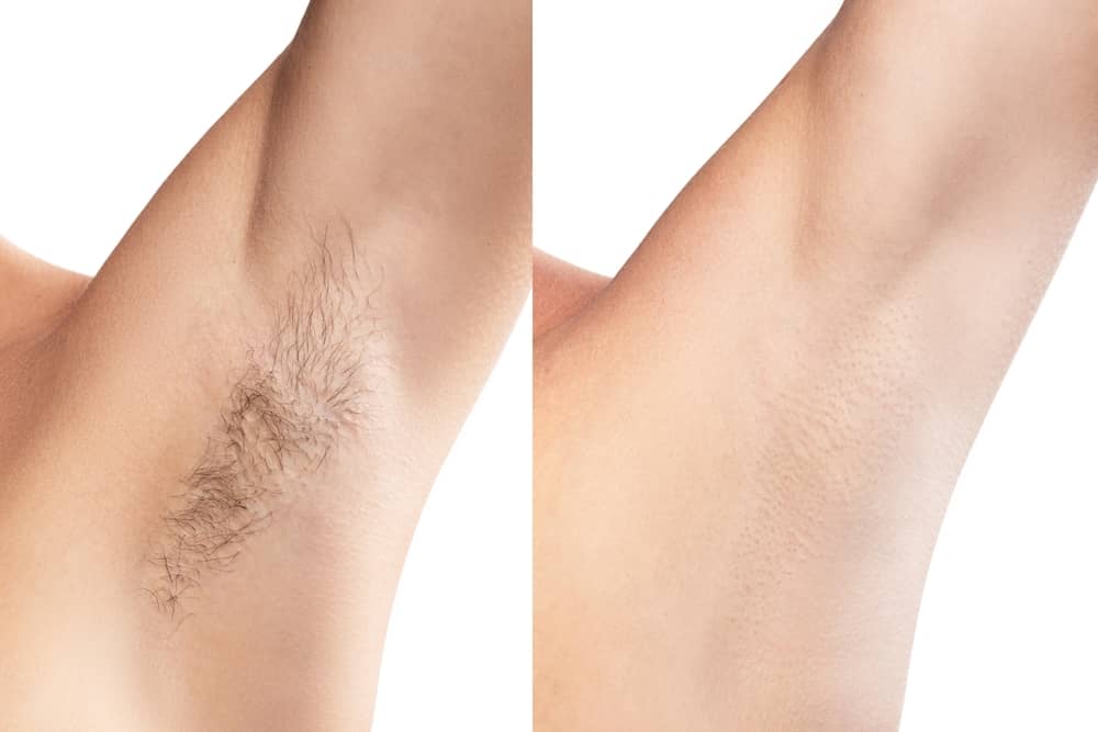 Before and after laser hair removal results showing underarm hair reduction from treatment