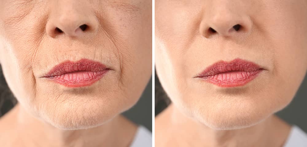 Before and after non-surgical lower face rejuvenation showing improved jawline definition and reduced marionette lines using hyaluronic acid fillers