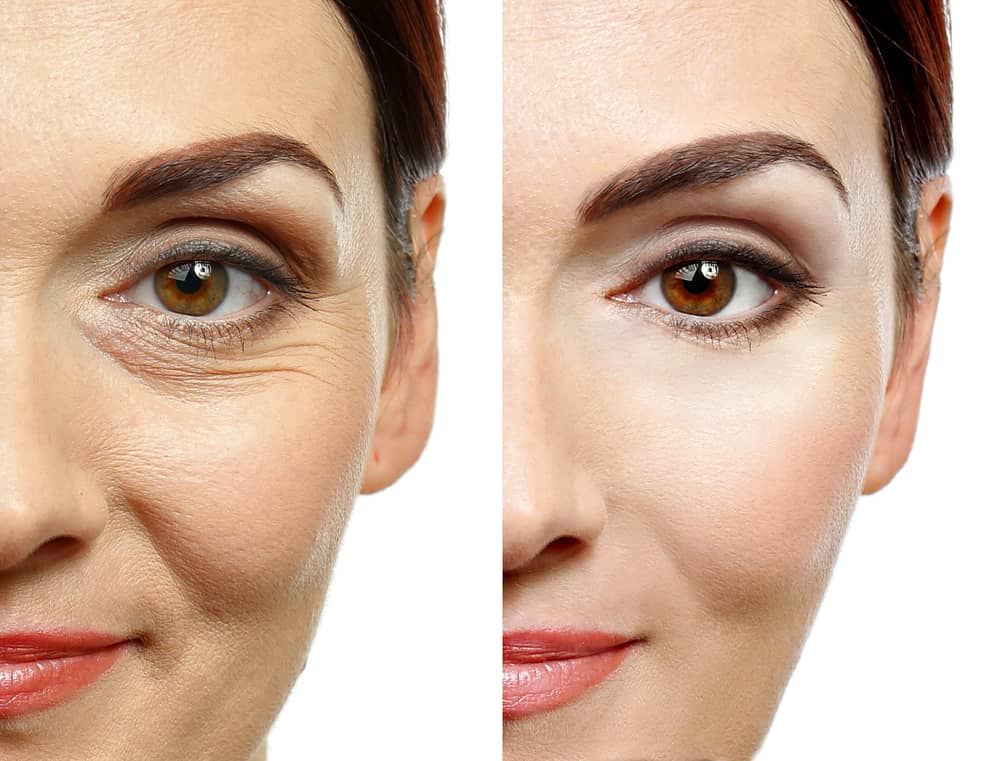 Before and after comparison showing dramatic reduction of crow's feet and wrinkles around woman's eye area, demonstrating results of RF microneedling skin tightening treatment with smoother, firmer skin texture